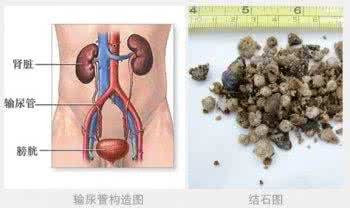 肾结石的有效治疗方法 【大病巧治】肾结石的有效治疗方法