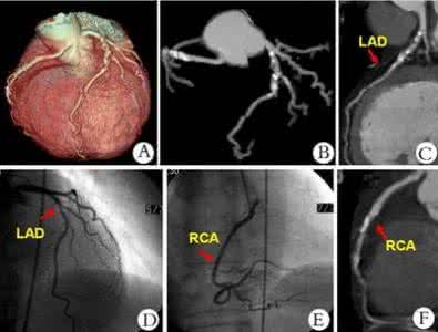冠状动脉疾病影像学 冠状动脉疾病影像学 影像学如何评估冠状动脉疾病