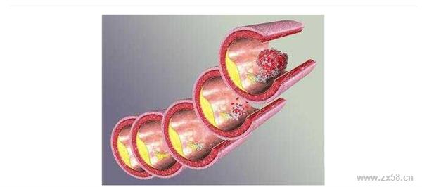 高血糖高血脂食谱 【转载】治疗高血糖、血脂、血液黏稠度高的三个偏方【转】