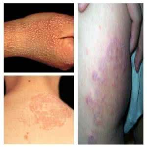 皮肤癣老中医 皮肤癣怎么治 老中医教你饮食治疗