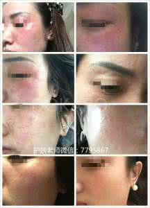 激素依赖性皮炎 激素依赖性皮炎 警惕化妆品中毒引发激素依赖性皮炎