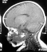 国宝秘方 国宝秘方:乙型脑炎屡治屡愈夺痰定惊汤