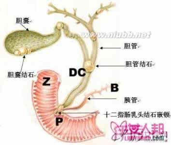 胆囊切除术后综合征 胆囊切除术后综合征 它是什么原因造成的