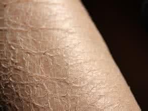 先天性鱼鳞病的治疗 先天性鱼鳞病 先天性鱼鳞病如何治疗