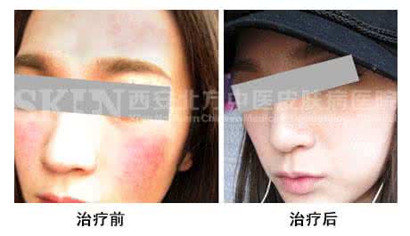 脸上红血丝怎么消除 脸上红血丝怎么消除? 6招永别红血丝