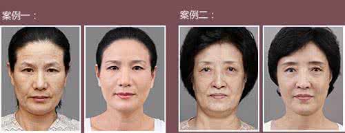 拉皮除皱手术多少钱 拉皮除皱手术多少钱 怎么选择适合自己的除皱手术