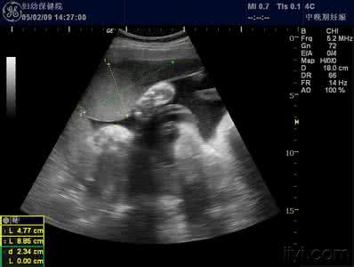 胎盘早剥 胎盘早剥 通过B超检查胎盘早剥