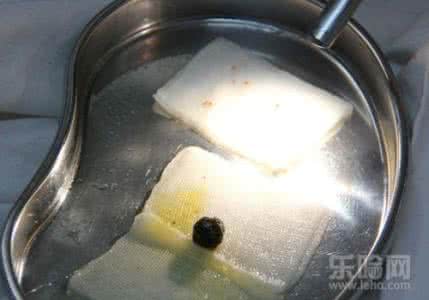泥沙型胆结石最佳秘方 国宝秘方:胆结石术后呃逆不止一剂痊愈海螵蛸汤