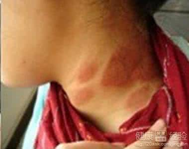 神经性皮炎传染吗 神经性皮炎传染吗 要如何预防神经性皮炎