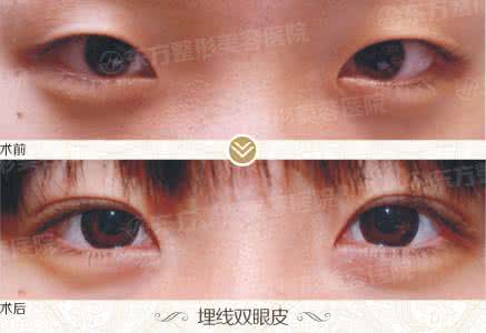 切开双眼皮会留疤吗 切开双眼皮会留疤吗 切开法双眼皮留疤吗