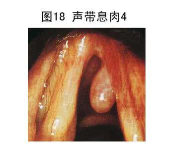 喉咙声带小结怎么办 喉咙声带息肉怎么治疗？