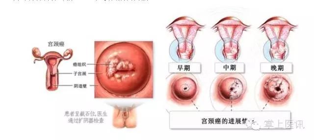 宫颈炎和宫颈癌的区别 宫颈炎会导致宫颈癌吗 这4个原因会导致宫颈癌，出现这3种症状就要小心了