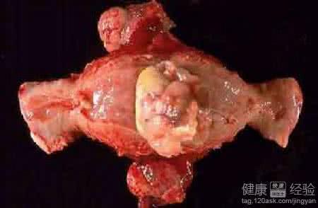 子宫肉瘤的早期症状 子宫肉瘤 子宫肉瘤有哪些症状