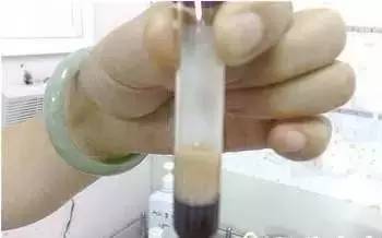 血脂高血粘稠怎么治疗 超简单：治疗血脂高、血粘稠的方法