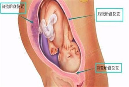 前壁和后壁哪个容易生 胎盘前壁和后壁的区别