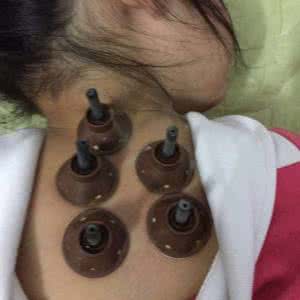 干眼病最佳治疗法 原创艾灸干眼病