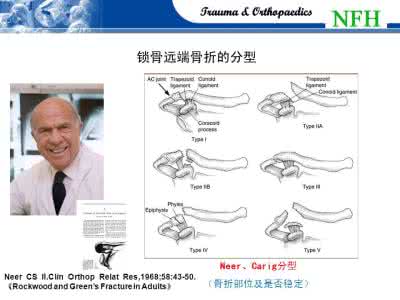 锁骨钩钢板固定视频 解剖钢板和克氏针内固定治疗对锁骨中段骨折患者肩关节功能及并发症的影响比较