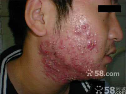 三棱针 三棱针挑刺身柱穴治疗痤疮96例