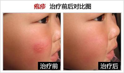 头部疱疹的治疗方法 疱疹的治疗方法 怎么样治疗疱疹比较好