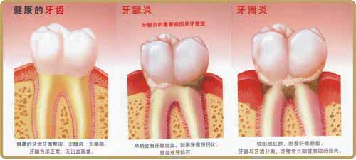 牙周炎怎么治疗小偏方 牙周炎怎么治疗 如何有效的预防牙周炎