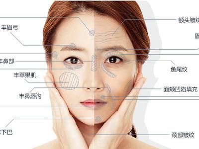 伊维兰注射额部填充术 注射面部填充材料 额部填充术材料如何选择?
