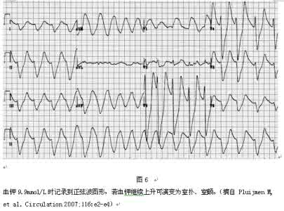 高钾血症心电图表现 【心电学】高钾的心电图改变和影响因素