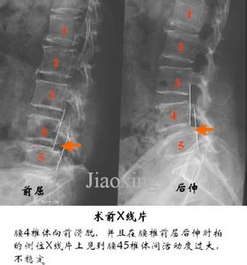 腰椎间盘突出秘方 图文：腰椎间盘突出特效秘方（转）