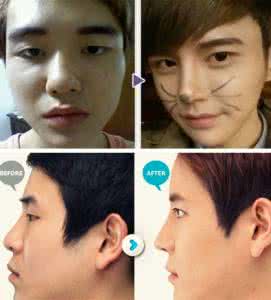 男人隆鼻前后对比 男人隆鼻前后对比 男人隆鼻