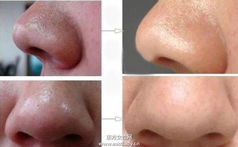 教你去除黑头的妙招 教你10招有效去除黑头