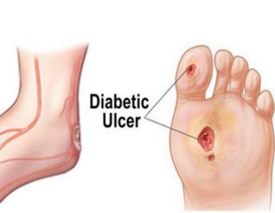糖尿病足怎么预防 糖尿病足怎么预防 怎样预防糖尿病足的发生