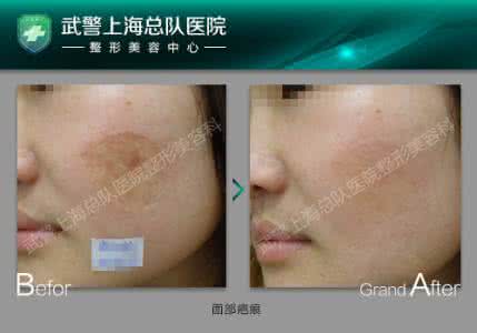 奥薇塔 怎么去痘痘疤痕 可以用奥薇塔胶原贴敷料吗