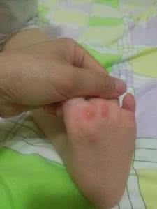 丘疹性荨麻疹如何治疗 丘疹性荨麻疹的治疗 丘疹性荨麻疹如何预防