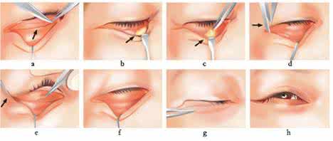微创去眼袋手术伤口 祛眼袋手术 微创去眼袋