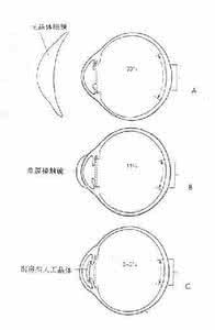 白内障形成原因 白内障形成原因 4个因素让你的视野不再清晰