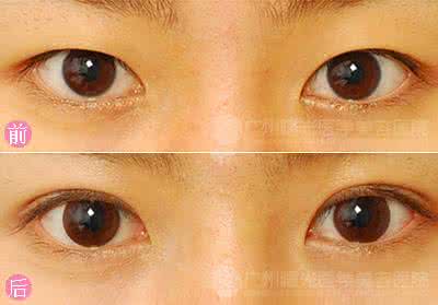 上睑下垂手术永久的么 上睑下垂手术 上睑下垂手术的优缺点及适应症