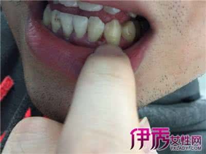 清除黑色牙菌斑的妙招 牙齿结石 定期给牙齿清除菌斑和结石