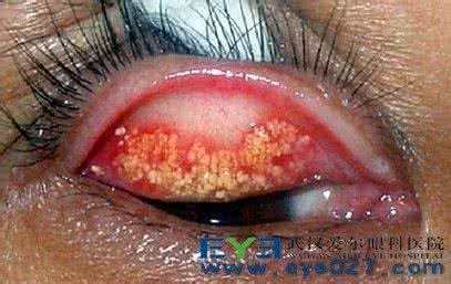 眼结石的症状及治疗 眼结石的症状及治疗 眼结石 眼结石怎么治疗好得快