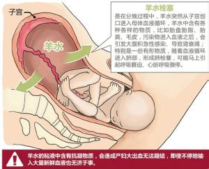 孕妇怎样预防羊水栓塞 “羊水栓塞”成孕妇夺命“瘟神”！如何有效预防“羊水栓塞”？