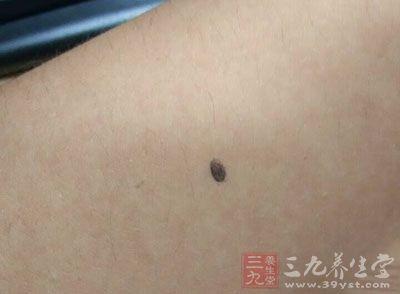 黑痣 超过1厘米 身上黑痣超过这个数竟会短命