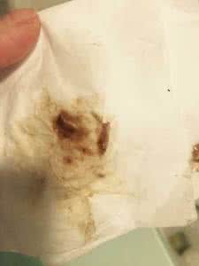 怀孕初期咖啡色分泌物 怀孕初期咖啡色分泌物 怀孕初期咖啡色是什么症状