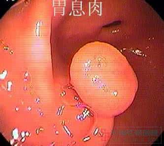 胃肠道息肉 胃肠道息肉 胃肠道息肉 它对肠道健康的威胁很大