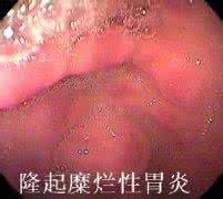 治疗糜烂性胃炎特效药 糜烂性胃炎 中西医临床治疗最佳特效方