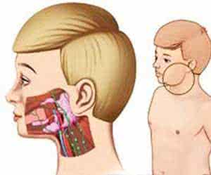 透皮技术 【透皮技术】连载25：儿科——小儿流行性腮腺炎