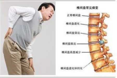 腰椎间盘突出病理 腰椎突出 腰椎突出的临床分型及病理