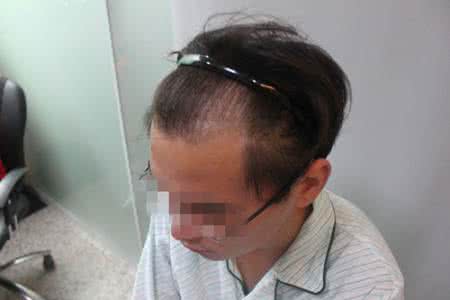 牙齿脱敏治疗具体方法 治疗脱发秘方 治疗脱发的秘方具体方法介绍