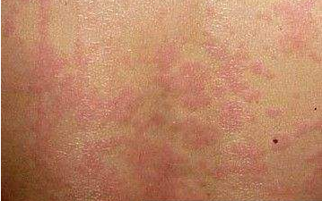 急慢性荨麻疹 急慢性荨麻疹29方