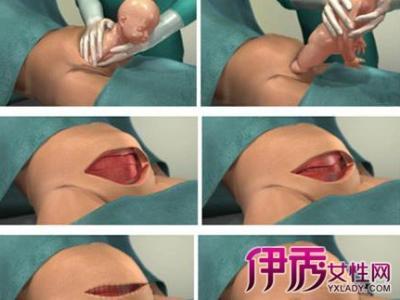 剖腹产怎么促进排恶露 剖腹产后怎么快速排恶露