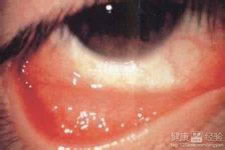 眼睛结膜炎怎么治疗 结膜炎怎么治疗 保护眼睛治疗结膜炎