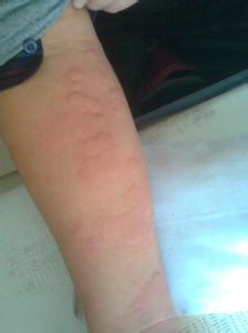 过敏性皮炎偏方不复发 过敏性皮炎3方