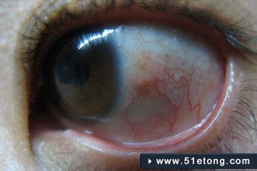 结膜炎的症状及治疗 结膜炎的症状及治疗 结膜炎怎么办